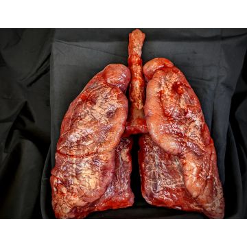 Body Part: Lungs