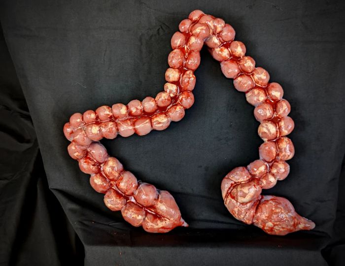 Body Part: Large Intestine