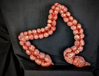 Body Part: Large Intestine