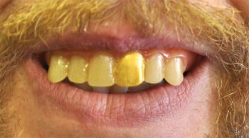 Teeth Glow Gold Miner